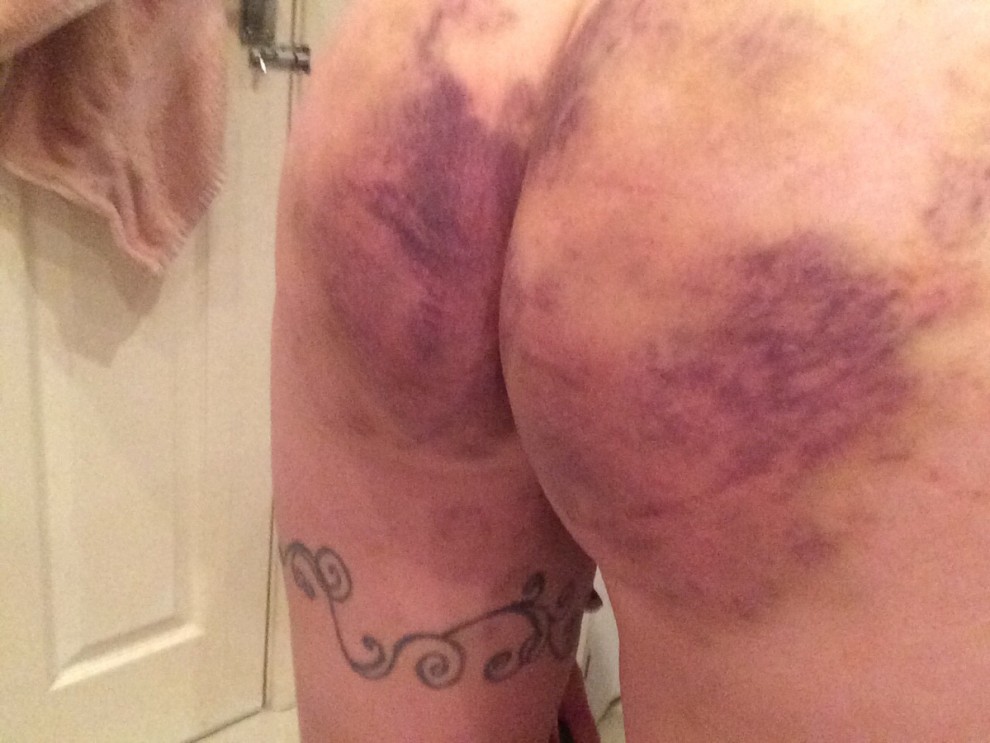 [f]ollow up: bruises from Tuesday's session have come out!