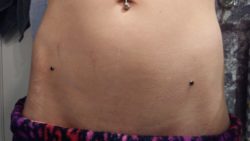 First set of dermals