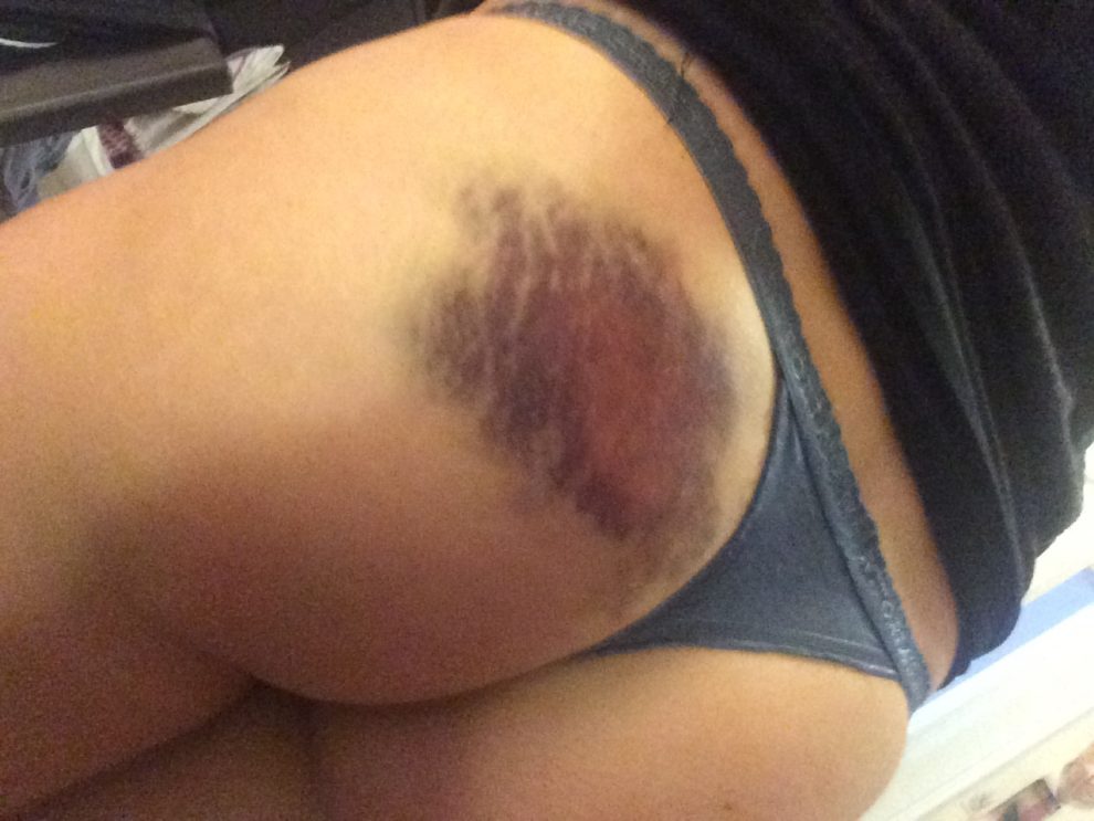 bruised butt